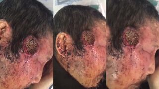 A Man Has Maggots On His Head