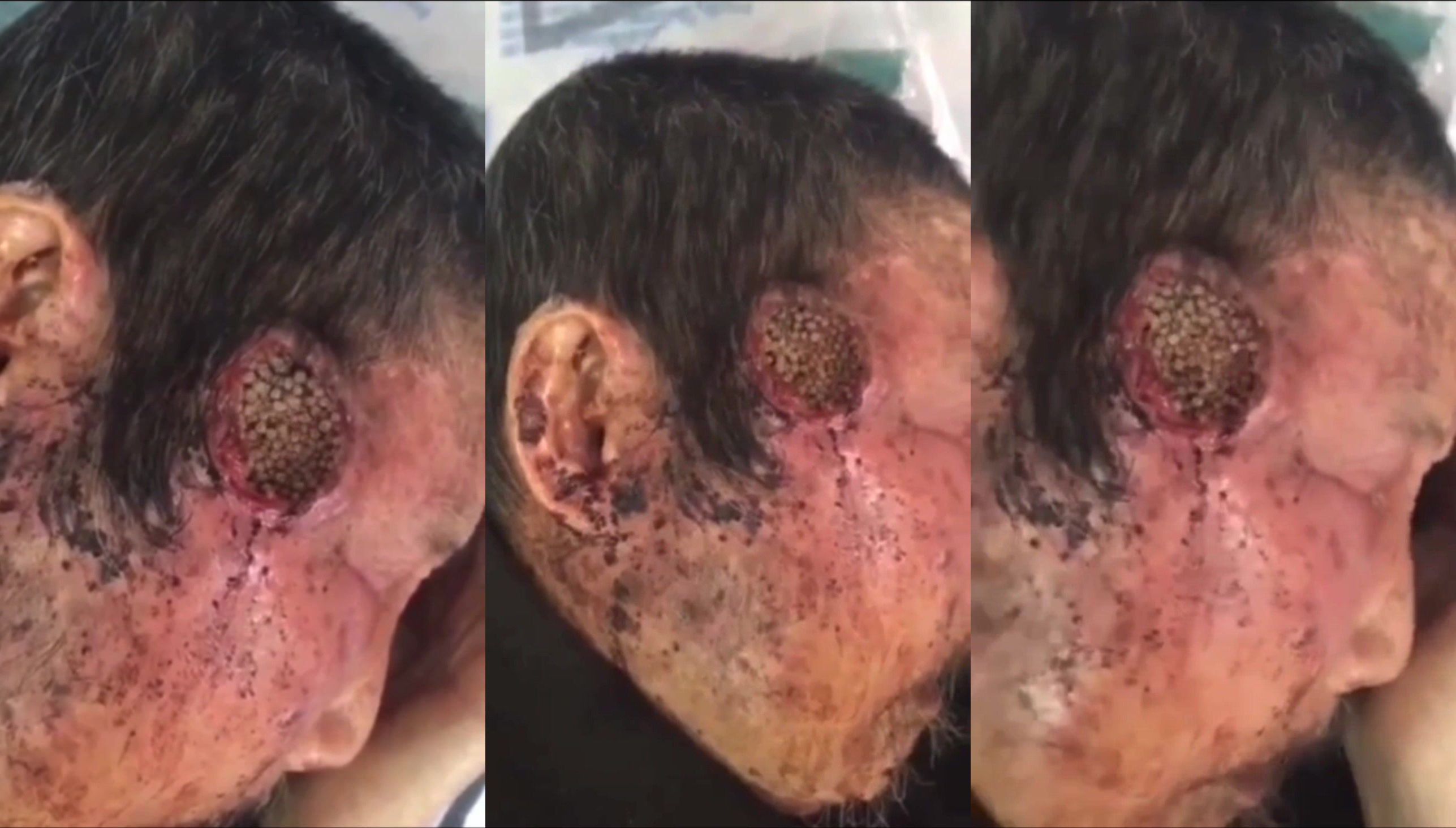 A Man Has Maggots On His Head