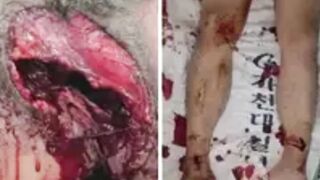 Medical aftermath compilation