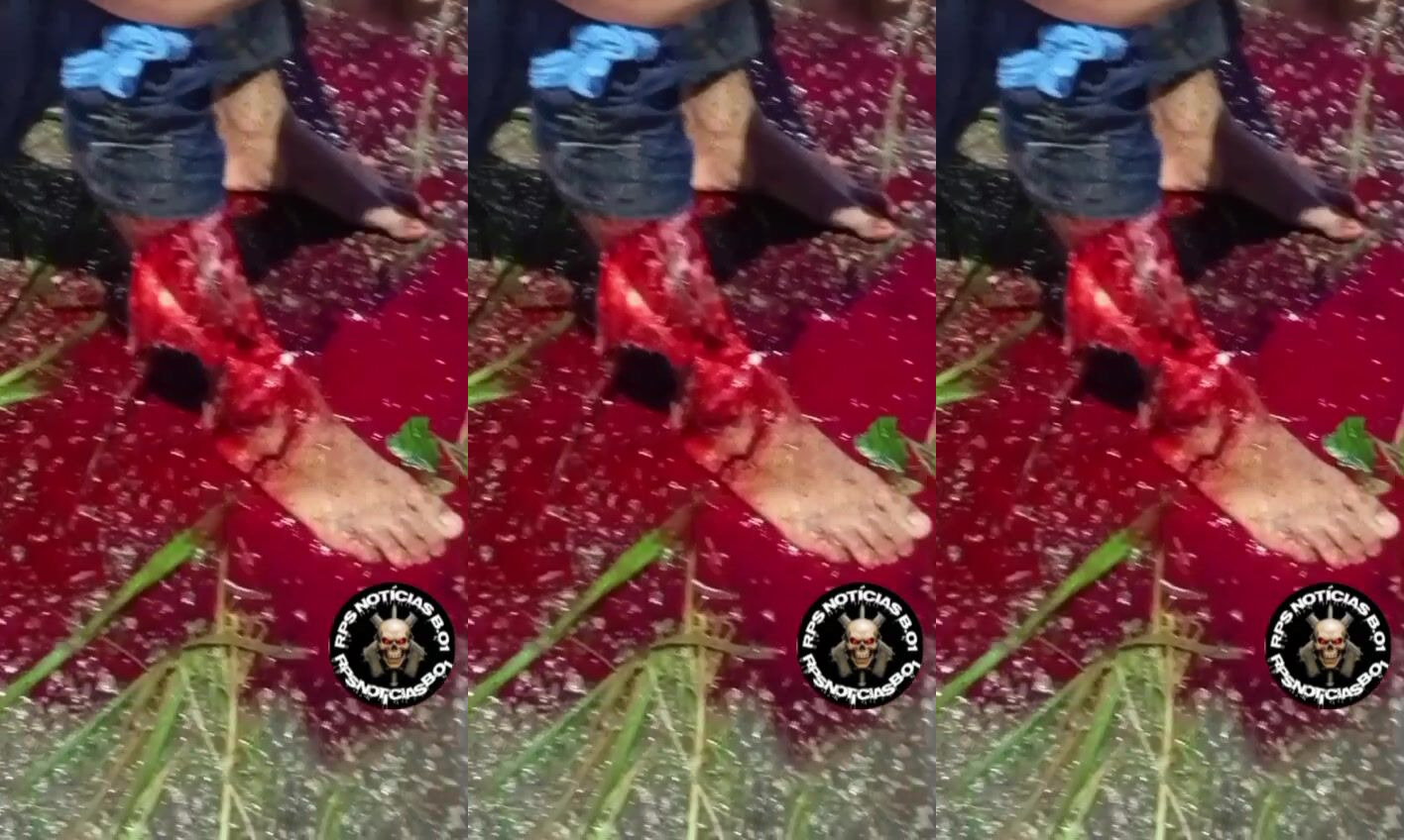 victim with destroyed leg