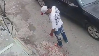 Man Lost Palm During Machete Fight