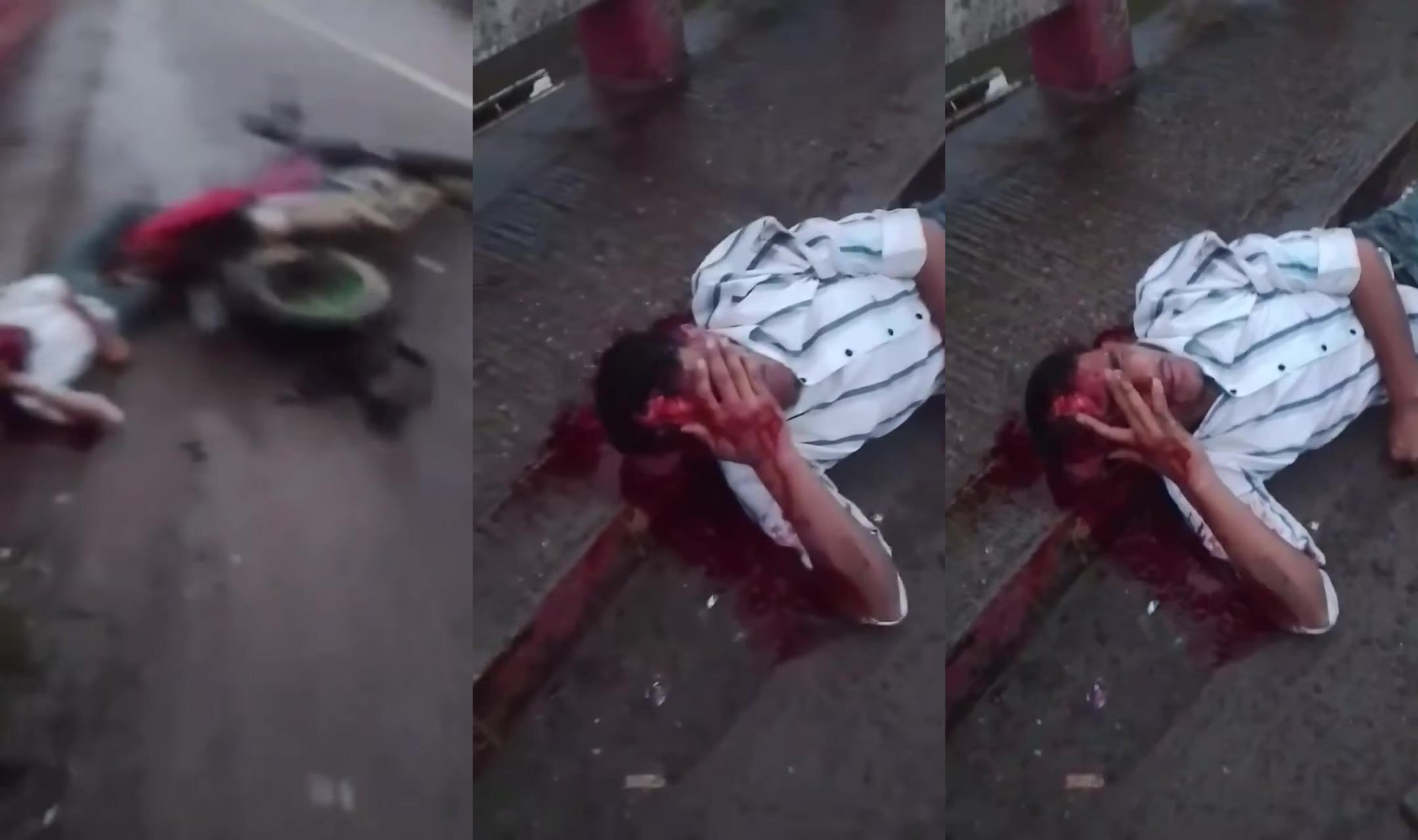 Man Partlially Scalped Following Motorcycle Accident