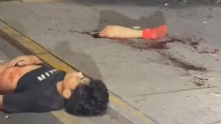 Man Shocked And Silent After Losing Leg In Traffic Accident