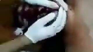 Classic: A guy slipped and sustained a fatal head injury (Face split diving accident)