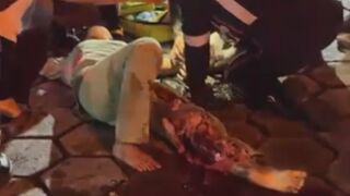 Poor Woman Suffers Terrible Leg Injury Fully Awake