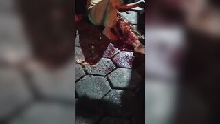 Poor Woman Suffers Terrible Leg Injury Fully Awake