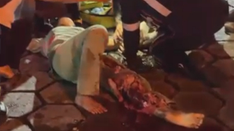 Poor Woman Suffers Terrible Leg Injury Fully Awake