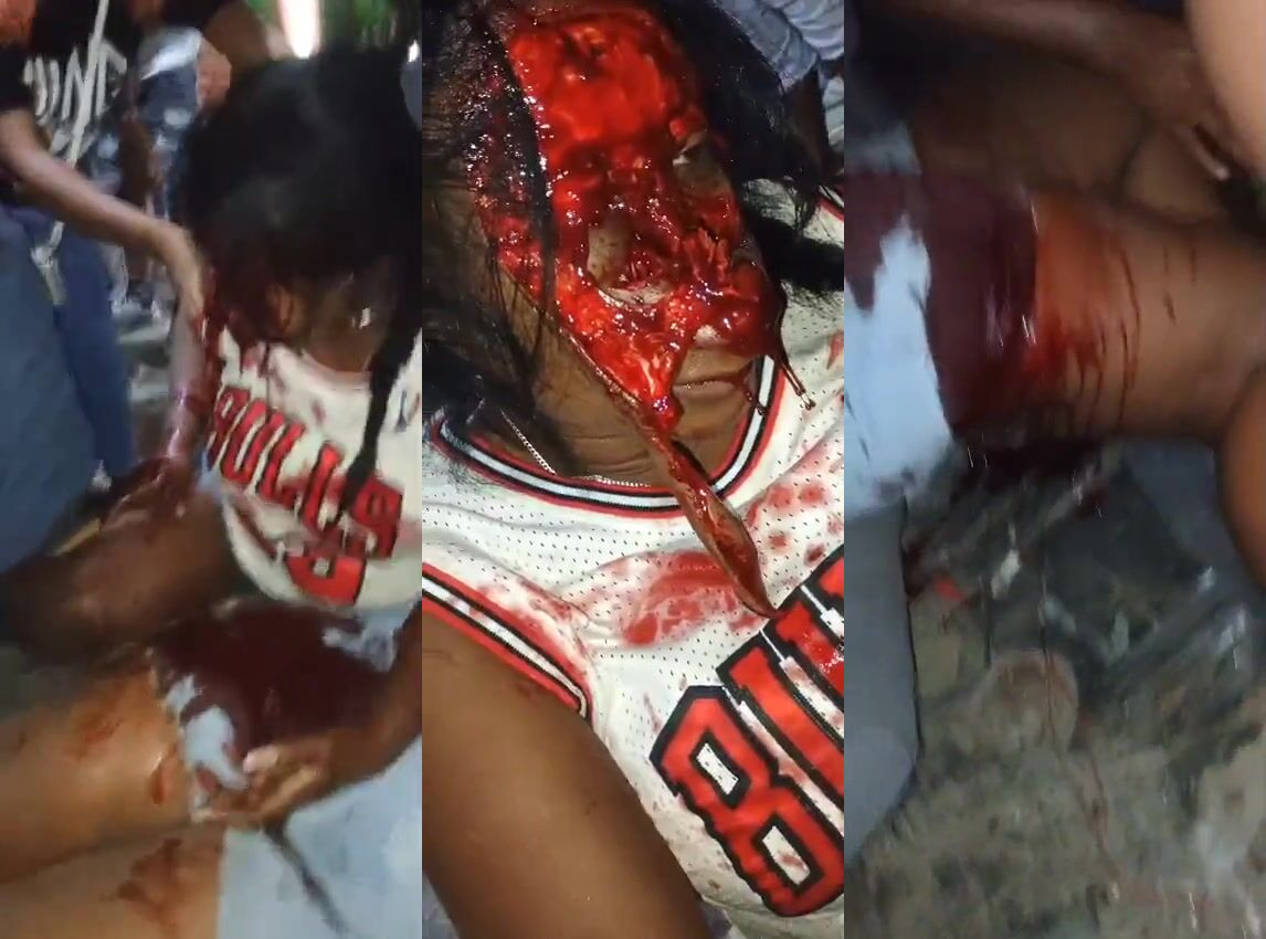 Two women in car crash. One of them lost her face.