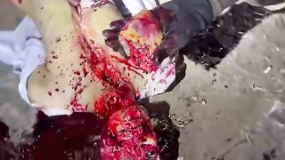 Classic: A guy gets flayed while being heavily sedated (The Zacatecas Flaying)