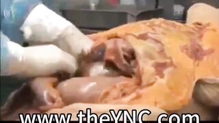Medical Reference: Autopsy Of A Male