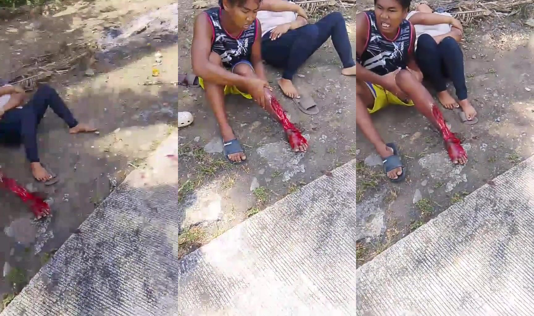 Leg stripped to the bone in moto accident