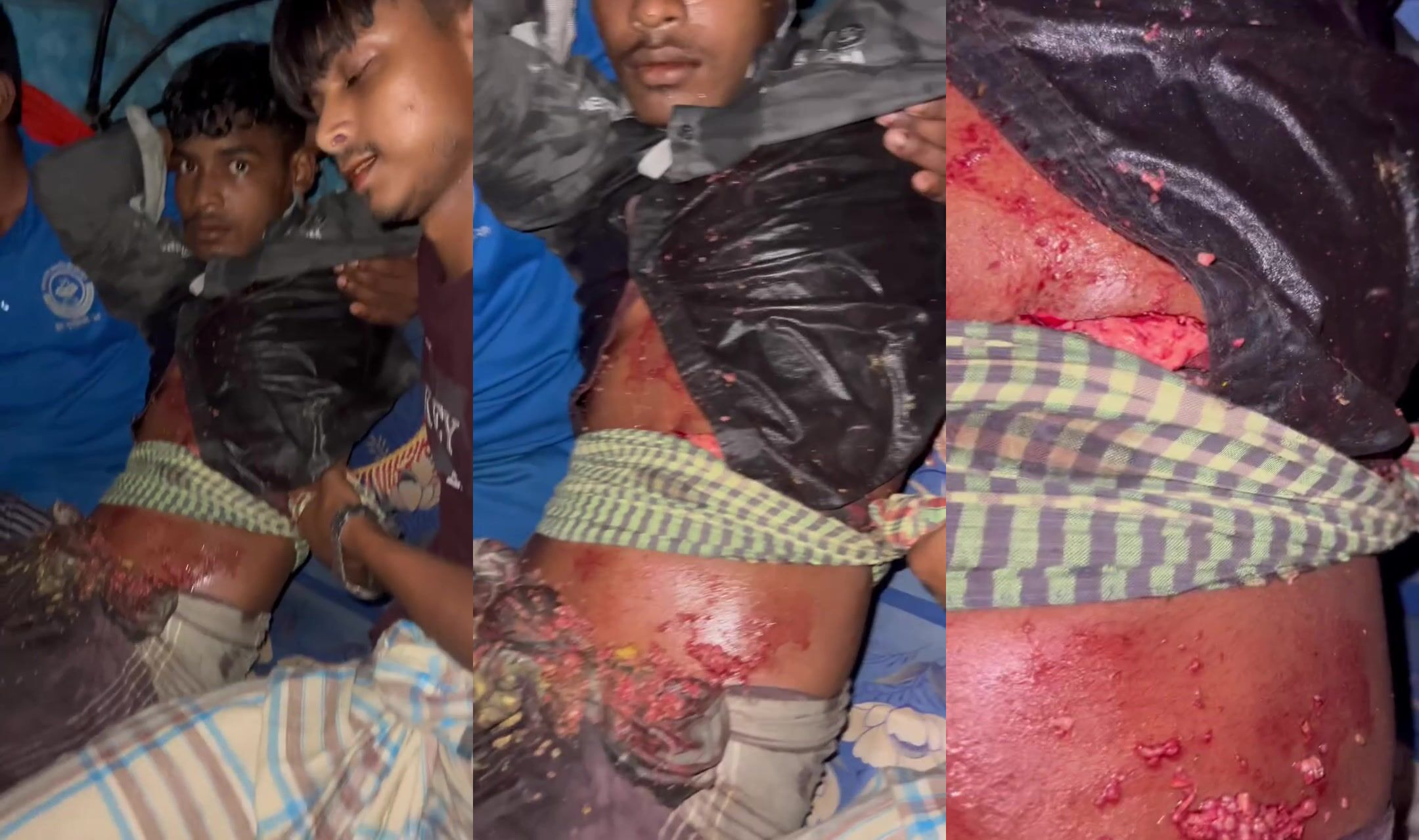 Adipose tissue on his belly after stabbed