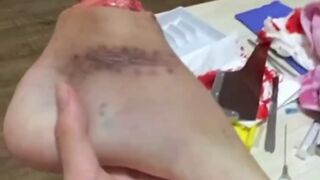 PLAYING WITH AMPUTED FOOT
