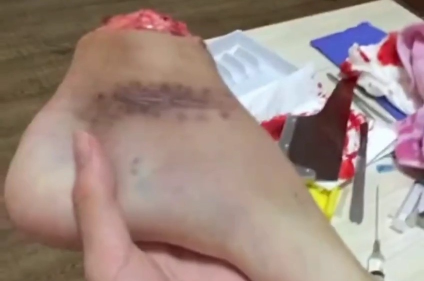 PLAYING WITH AMPUTED FOOT