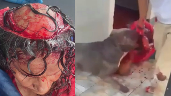 Woman Scalped During Pitbull Attack In Nicaragua