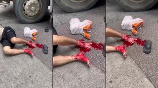 Foot stripped to the bone