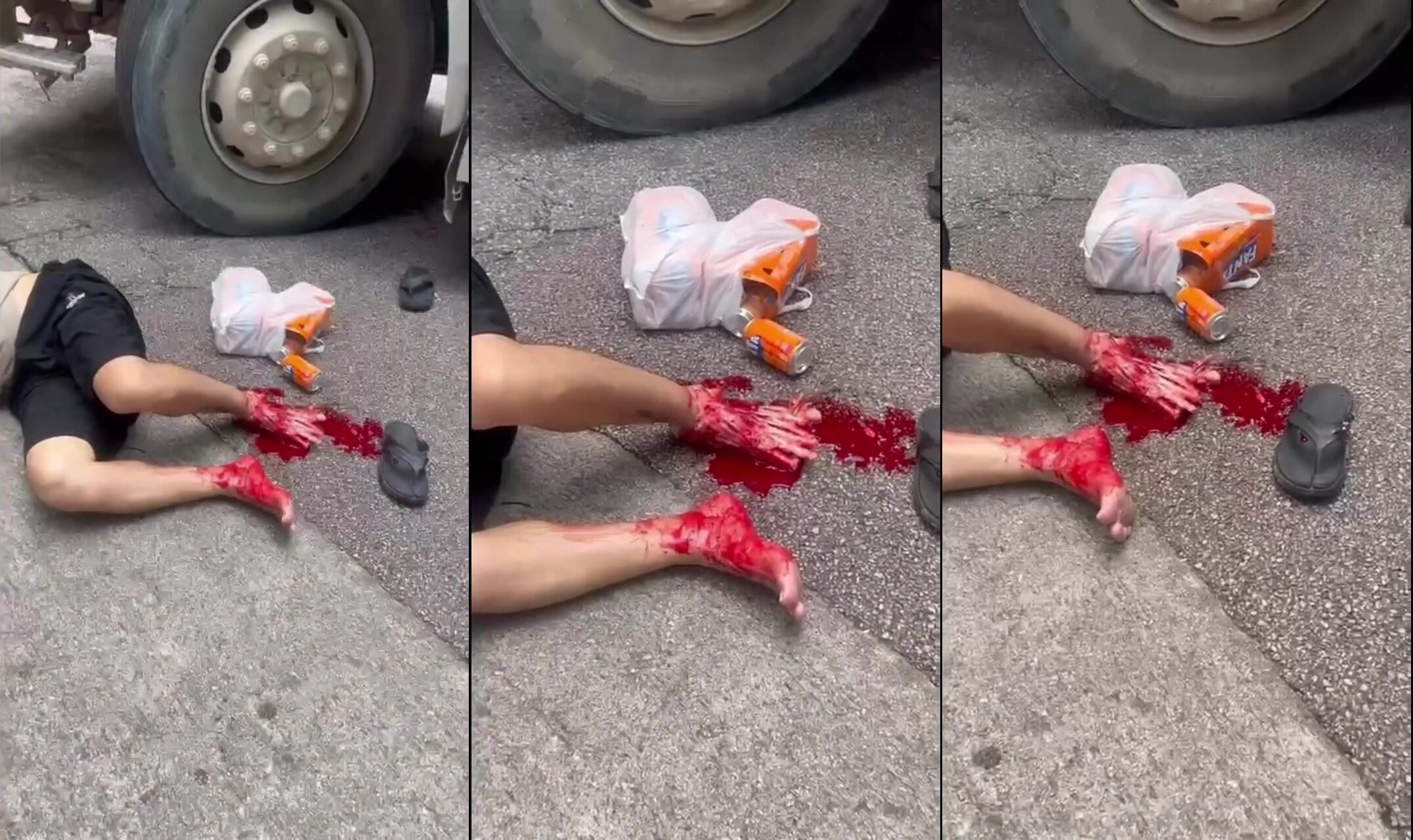 Foot stripped to the bone
