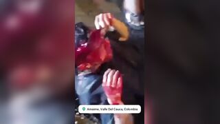 Motorcyclist Lost An Eye During Street Race In Colombia