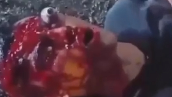 Motorcyclist Lost An Eye During Street Race In Colombia
