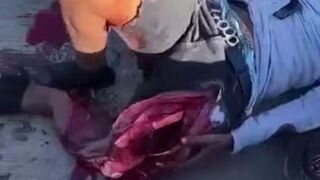 Biker's Leg Destroyed In Accident