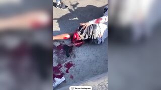 Biker's Leg Destroyed In Accident