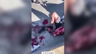 Biker's Leg Destroyed In Accident