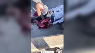 Biker's Leg Destroyed In Accident