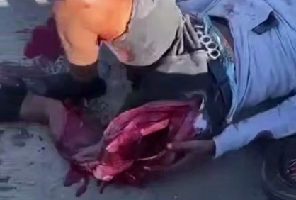 Biker's Leg Destroyed In Accident