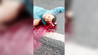 Skull Cracked And Bones Exposed - Aftermath Of Deadly Motorcycle Accident