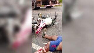 Skull Cracked And Bones Exposed - Aftermath Of Deadly Motorcycle Accident
