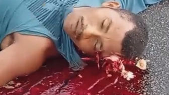 Skull Cracked And Bones Exposed - Aftermath Of Deadly Motorcycle Accident