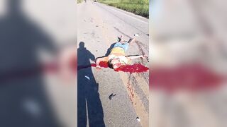 Skull Cracked Following Traffic Accident