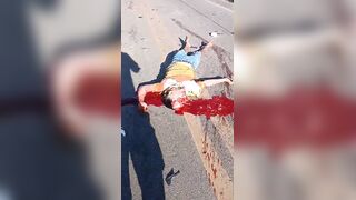 Skull Cracked Following Traffic Accident