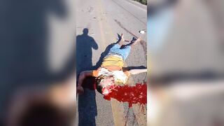 Skull Cracked Following Traffic Accident