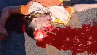 Skull Cracked Following Traffic Accident