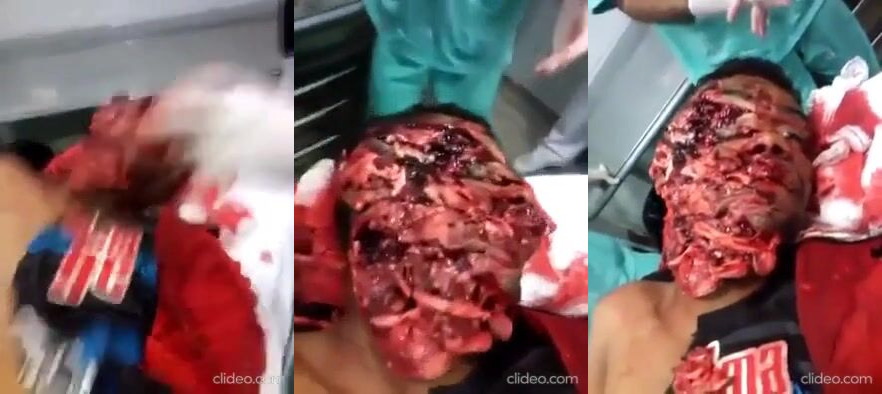 Dude With Machete Wounds to The Face & Doctors Laugh At The Noises He's Making (Classic Video)