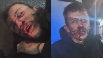 Phone Thief Having A Painful Night In Bogota