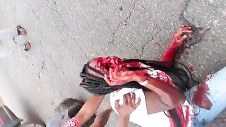 Woman Left With Huge Hole In Her Face