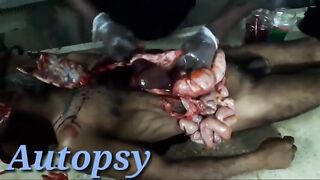 Full autopsy video