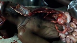 Full autopsy video