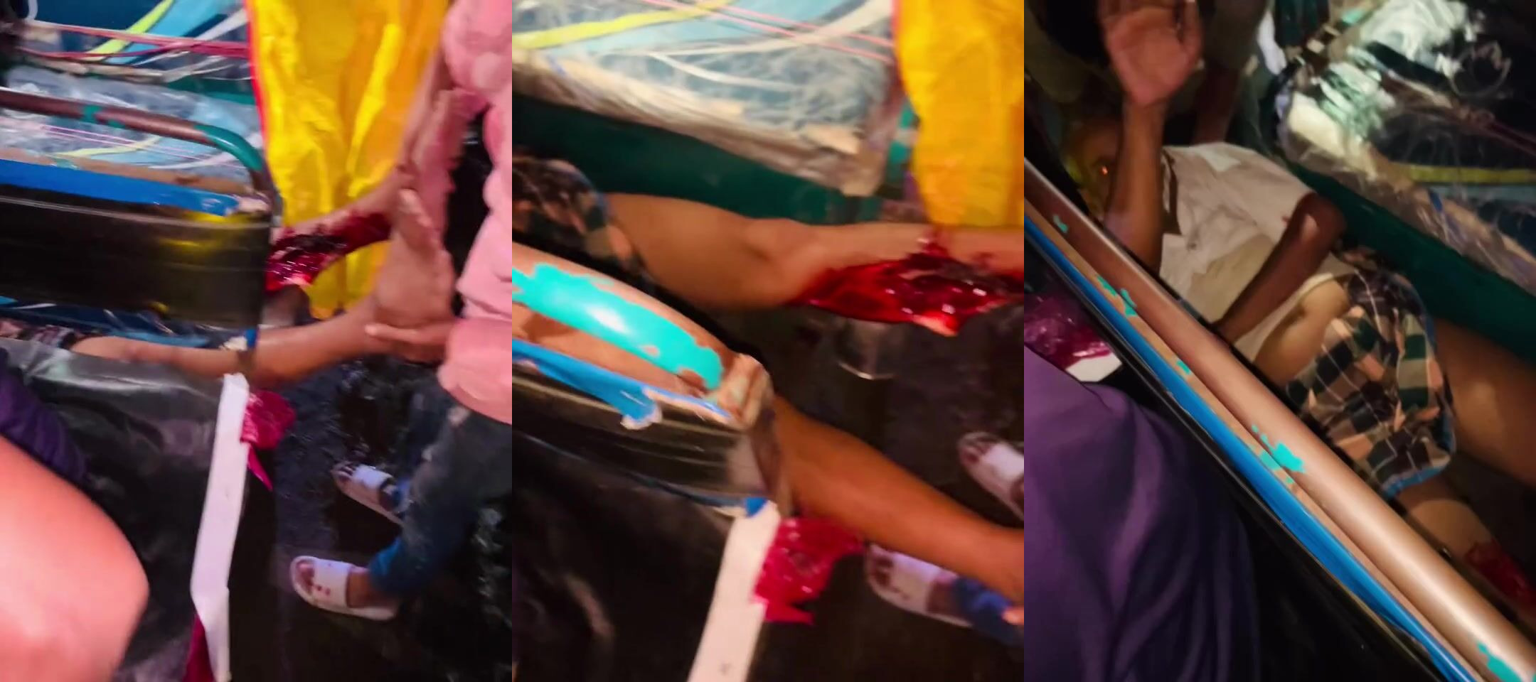 Broken femur in tuktuk accident