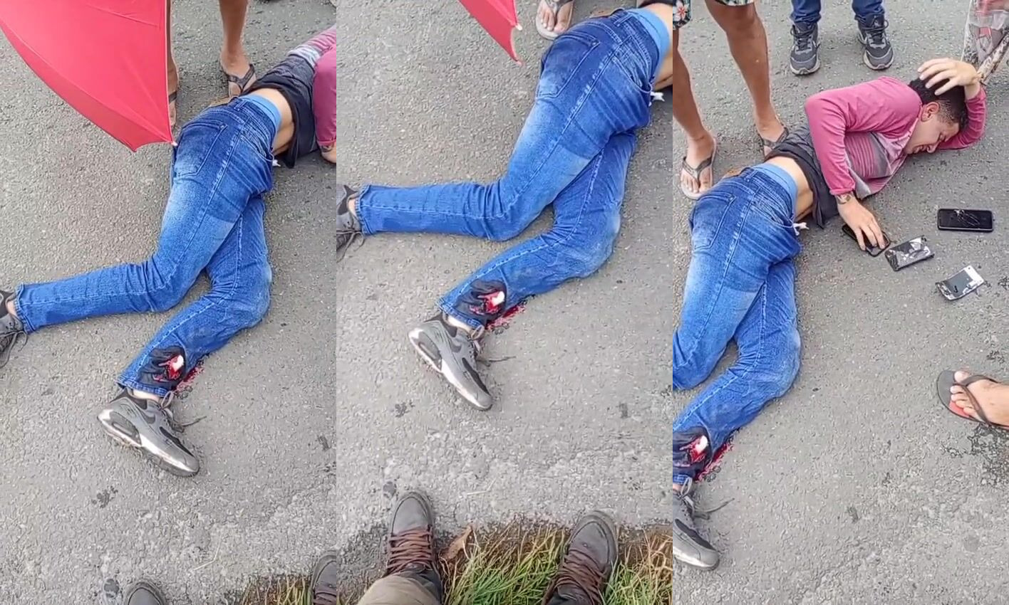 Motorcyclist`s Bone Exposed After Fender Bender In Brazil