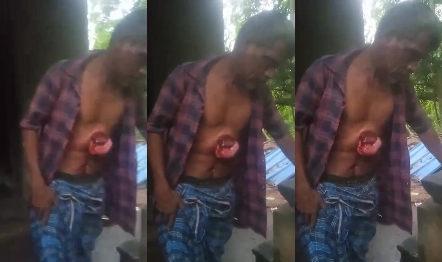 Intestines exposed after elephant attack