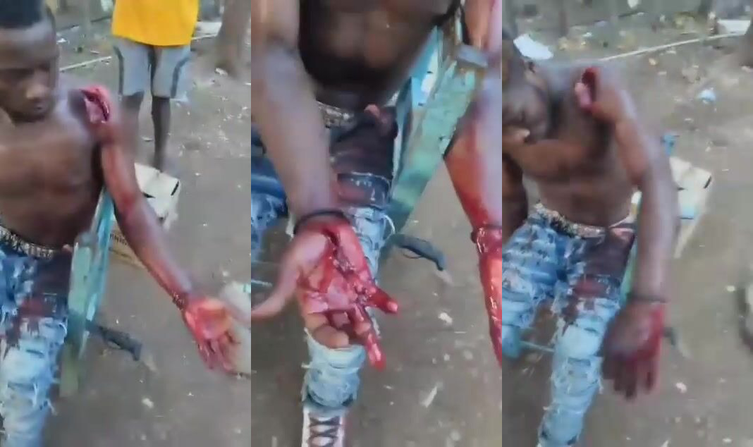 Machete Attack Survivor Takes it Like A Man