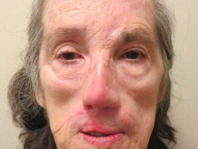 71-year-old female patient who sustained a severe midface soft tissue