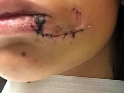 18 Yr Old Argentinian Face Mauled By Dog