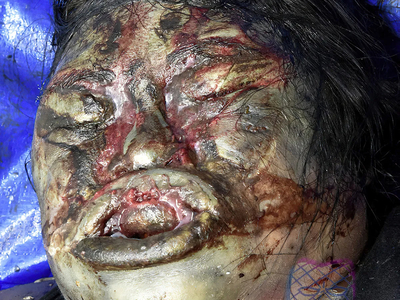An elderly woman in a state of advanced decomposition