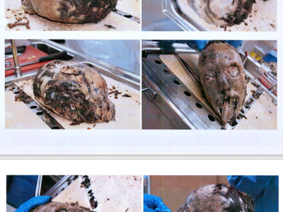 Autopsy images from Christian Larsson case