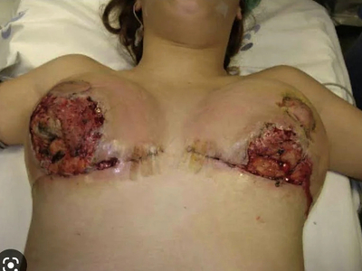 Pyoderma Gangrenosum After Breast Reduction