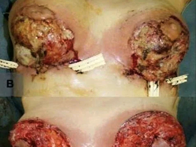 Pyoderma Gangrenosum After Breast Reduction